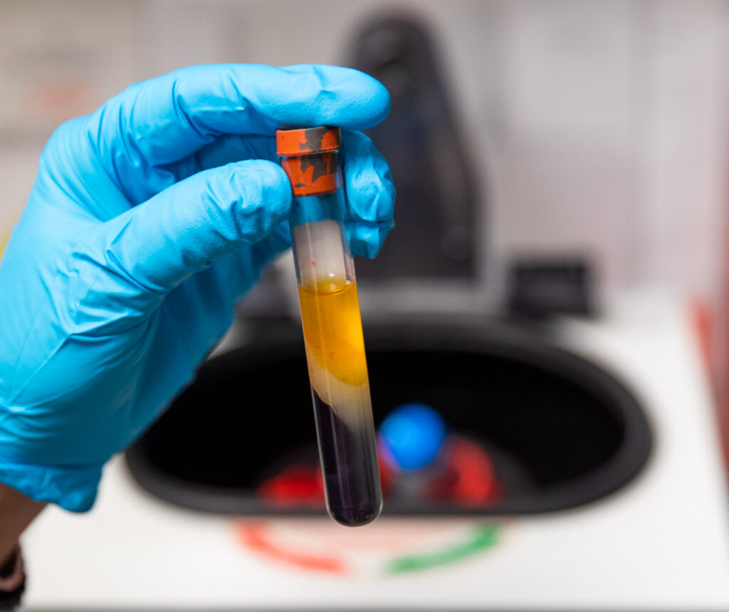 A vial of blood used in our male pattern baldness treatment in Thunder Bay, ON.