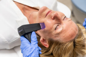 A woman smiles as she receives RF microneedling for skin rejuvenation in Thunder Bay, ON.