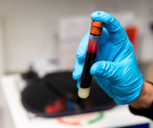 A vial of patient blood used in PRP hair treatment in Thunder Bay, ON.