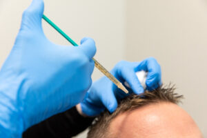 A member of our team makes an injection into a patient's scalp as a part of male pattern baldness treatment in Thunder Bay, ON.